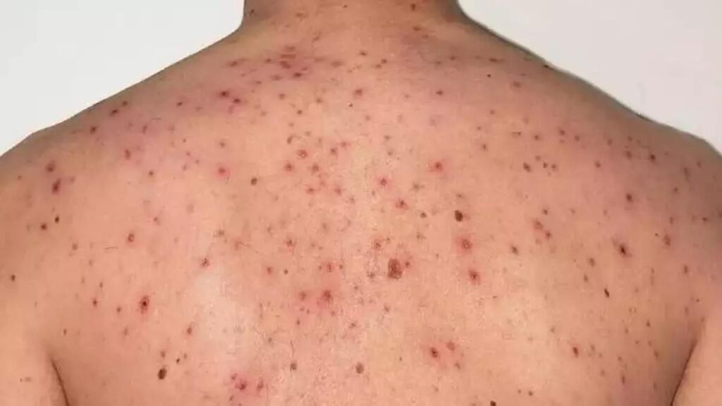 masern ausbruch teneriffa vier faelle bestaetigt